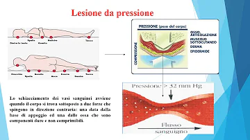 Che cosè la piaga?