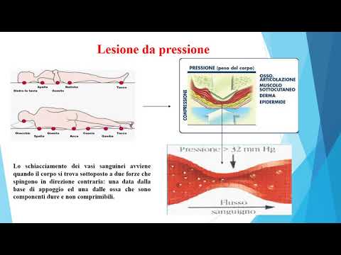 Video: Ulcere Da Decubito: Cause, Gradi, Luoghi Di Formazione, Trattamento, Prevenzione