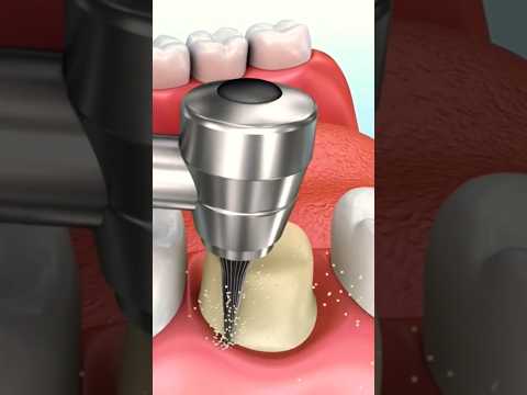 تراش روکش پروتز دندان پرسلن زیرکونیا ایمکس دندانپزشکی بریج دندانی