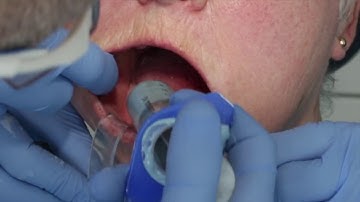 Primary impression for a complete lower (mandibular) denture