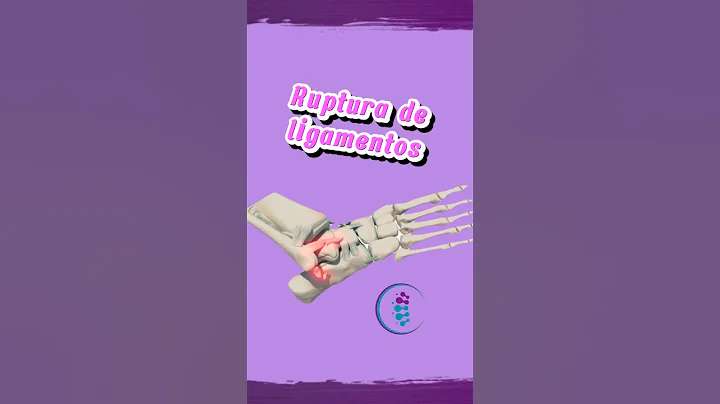 Así se ve una ruptura de ligamentos del tobillo ¿te ha pasado? 🥲 #tobillo #ligamentos #esguince