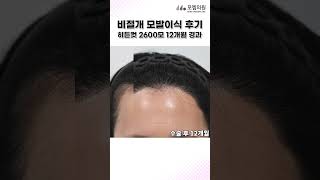 여성헤어라인모발이식 2600모 M자 머리심기 1년 후기 | 모엠의원(MOEM) | 히든컷