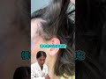 【乾癬】肌のターンオーバーの乱れで起きるフケの塊！ボロボロと剥がれ落ちる慢性の皮膚疾患！！