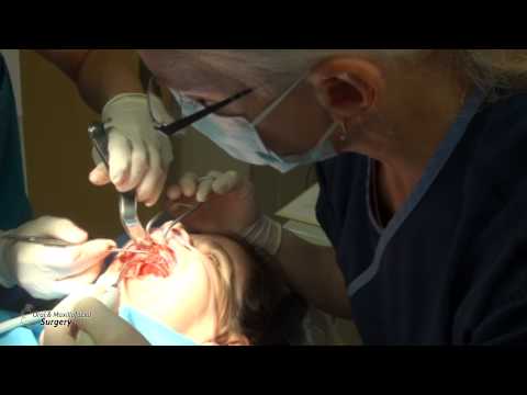 Sinus Lift Surgery. Part 02