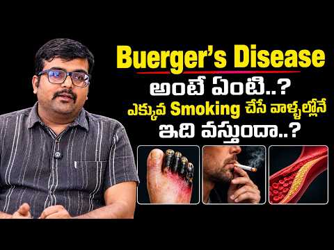 Smokers తప్పక తెలుసుకోవాల్సిన విషయం! | Buerger's Disease Symptoms & Causes | Dr. Sanjeeva Rao