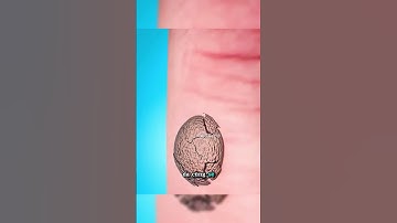 Tại Sao Không Nên Tự Ý Loại Bỏ Mụn Cóc và U Thịt? #shorts