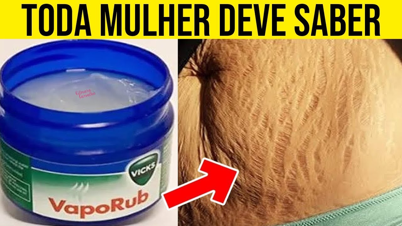 Resultado de imagem para Pomada com Vick Vaporub Para Eliminar as Varizes