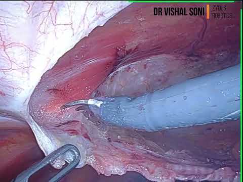 Robotic TARUP Meshplasty