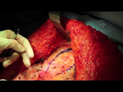 Live Surgery: What is an Abdominoplasty (Tummy Tuck) and Rectus Plication: Muscle Tightening