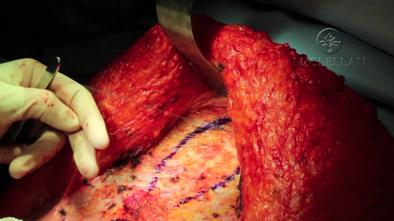 Live Surgery: What is an Abdominoplasty (Tummy Tuck) and Rectus Plication: Muscle Tightening