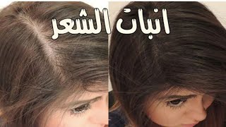 بخاخ ورق اللوري لانبات الشعر وزياده كثافته بديل لعمليات زراعه الشعر ?