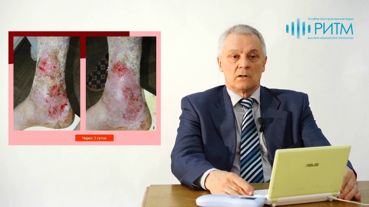 Профессор Тараканов. СКЭНАР и лечение ожогов