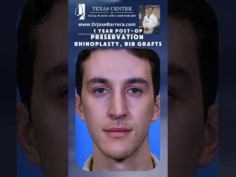 Video thumbnail: 1-year post-op results for his male patient following Preservation Rhinoplasty with rib  grafts · Dr. Jose Barrera