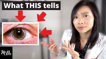 What is Corneal Arcus? | What you NEED to know