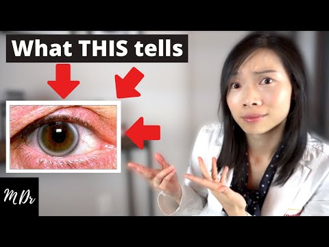 What is Corneal Arcus? | What you NEED to know