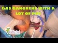 Gas Gangrene: Pus Pouring out of a Foot Tampa