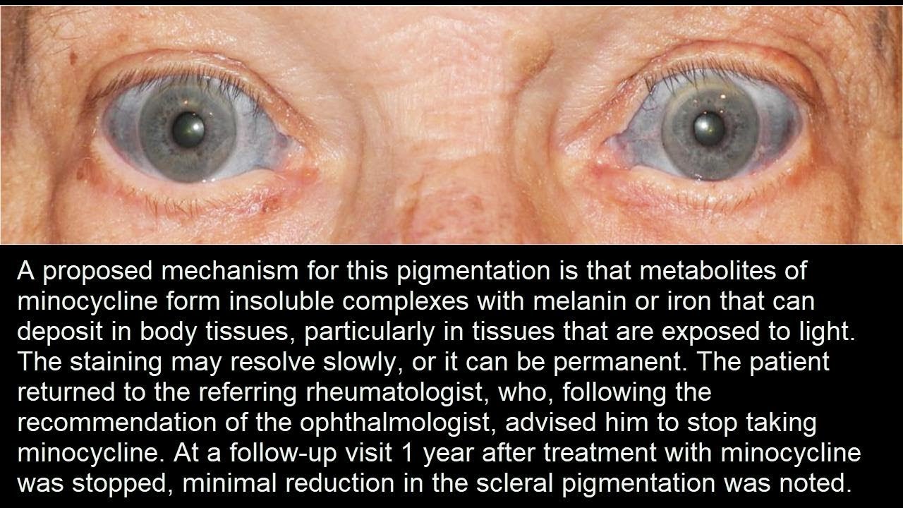 Sklerale Diskoloration unter Minozyklin