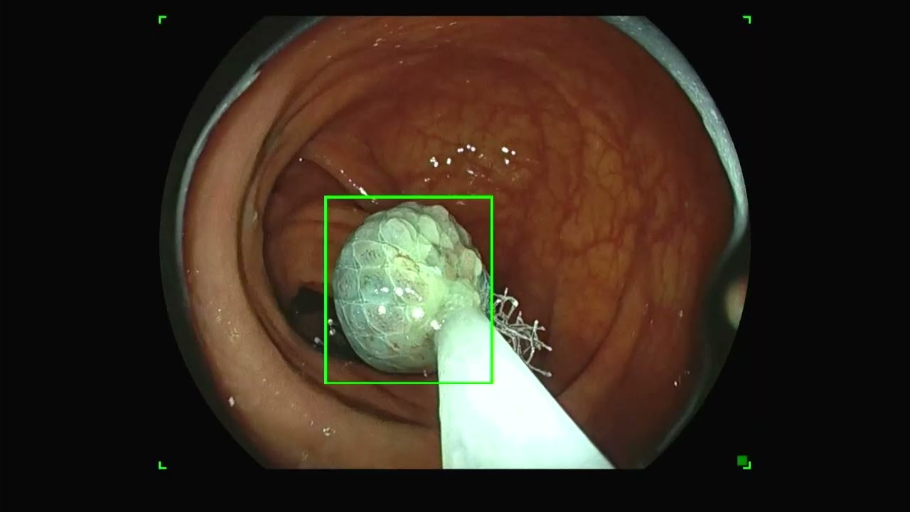 Colonoscopy-Polyp Retrieval-Roth Net-Mucosal Entrapment