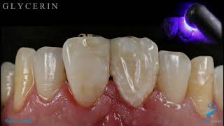 Aesthetic Composite Restoration - Broken Central Incisor