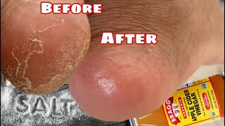 how to get BABY SOFT FEET at HOME using APPLE CIDER VINEGAR and SALT screenshot 2