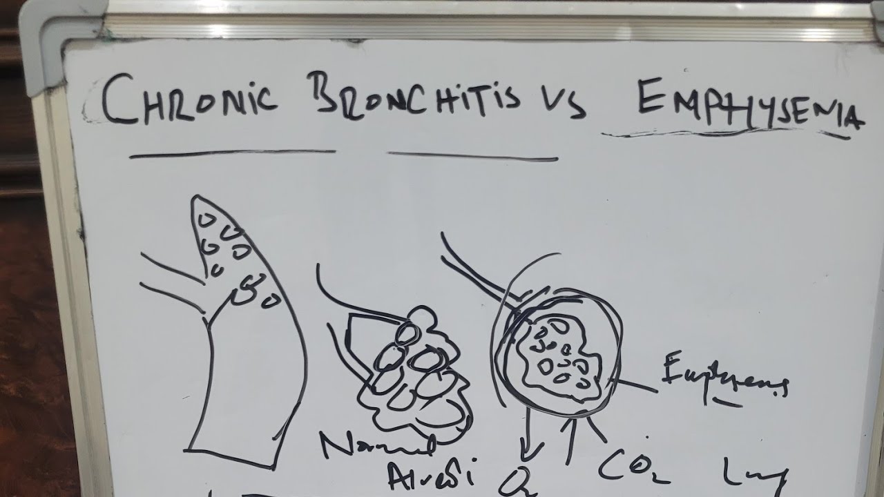 Bronchitis VS Emphysema complete lecture with explanation 😊😇 - YouTube