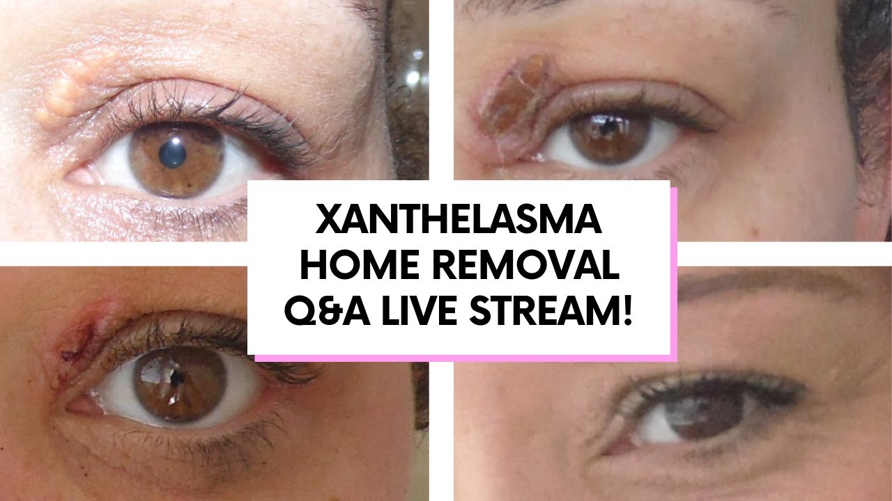 🛑 LIVE XANTHELASMA REMOVAL AT HOME Q&A HOW I REMOVED MINE WITH A