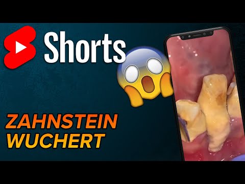 Video: Zahnstein entfernen: 10 Schritte (mit Bildern)