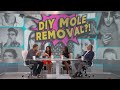 DIY Mole Removal?