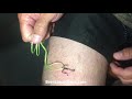 Quick and painless fish hook removal