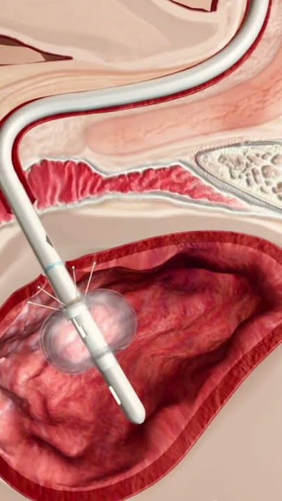 urinary catheter