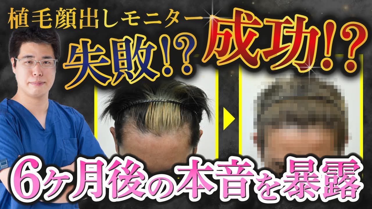 【手術後6ヶ月後インタビュー】顔出しモニターさんの植毛手術に密着
