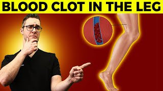 Blood Clot Symptoms & Signs [Causes & Treatment of Leg Blood Clots] screenshot 5