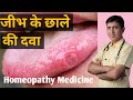       tongue ulcer treatment in hindi  jeebh ke chale ka ilaj tongue ulcer medicine