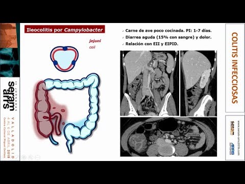 Vídeo: Cloacitis Infecciosa En Rèptils