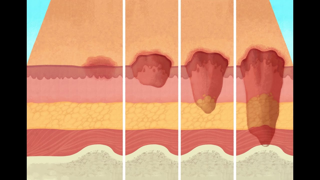 قرح الفراش | pressure ulcer محاضرة 8 ج2 جراحة