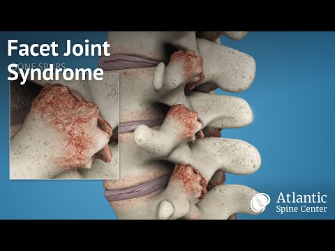 Facet Joint Syndrome