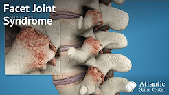 Facet Joint Syndrome