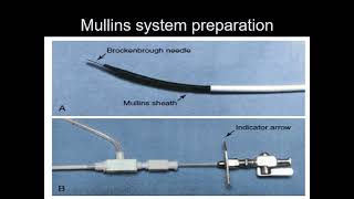 Balloon Mitral Valvotomy: How to get the best results, Prof. Osama Refaie