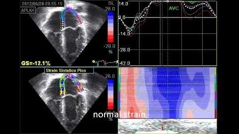 LEFT ATRIAL STRAIN for speckle tracking,step by step