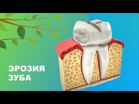 🦷 Эрозия зуба