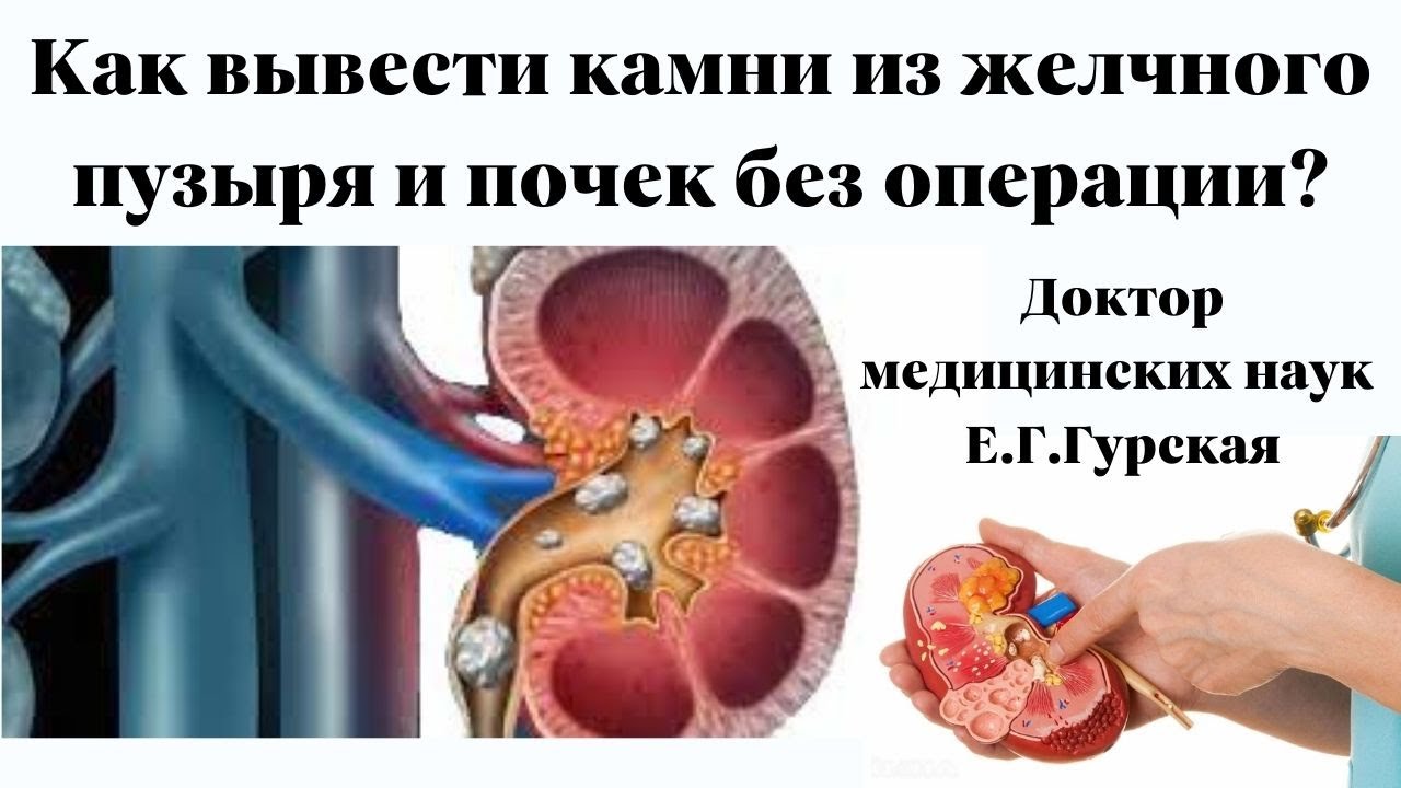 Камни в почках как без операции. Камни в почках и желчном пузыре. Вывод камней из почек без операции.