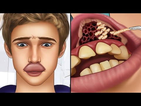 asmr-remove-botfly-maggots-found-inside-mountaineer's-mouth-|-dental-care-animation