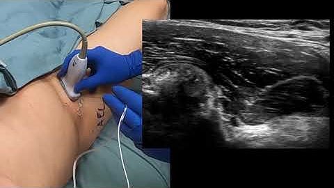 The Pericapsular Nerve Group Block for Perioperative Pain Management for Hip Art