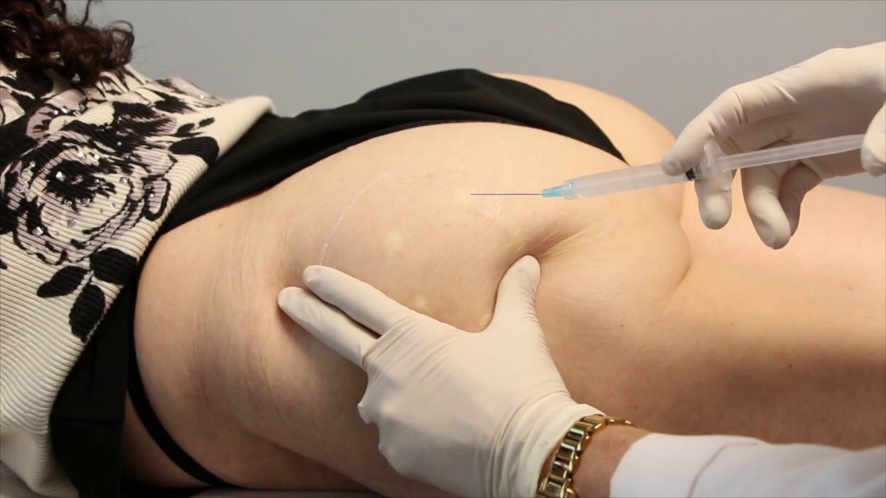 Banner for Injecting Sculptra on the Buttocks with Dr. Butterwick