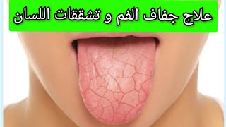 علاج جفاف الفم و تشققات اللسان Treatment of Dry mouth and fissured tongue