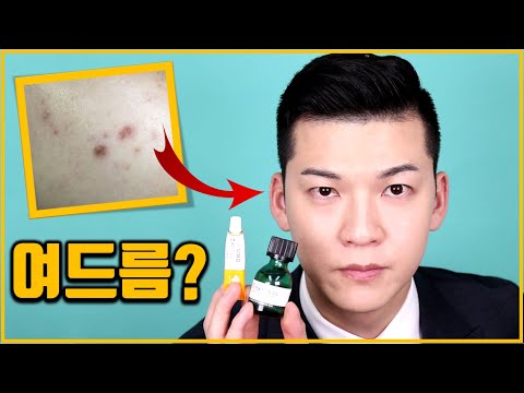 [Eng] How I got rid of acne, scars in a month! (Squeezing, Tea tree oil, Patch etc.) CLASSSY #203