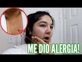 Tome Antibióticos Que Me Causó Una Reacción Alérgica 🥴‼️  | 12.15.23