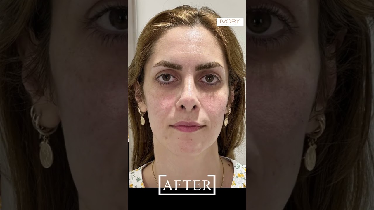 Profhilo + Fillers - Ivory Aesthetics Dubai