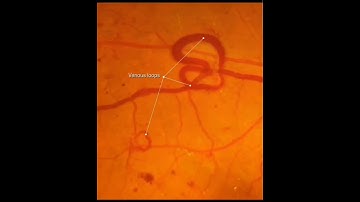 Diabetic retinopathy #viral #eyecheckup #education #shortsvideo #shorts #trendingshorts