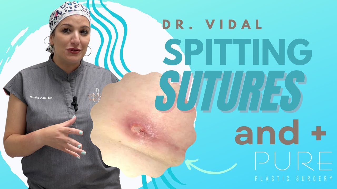 Spitting Sutures YouTube